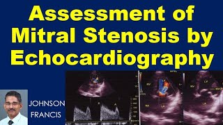 Assessment of Mitral Stenosis by Echocardiography [upl. by Shermie]