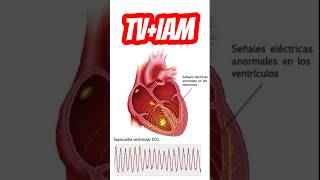 Cardioversión ⚡️en TV  SCA🫀 emergency uci [upl. by Otokam]