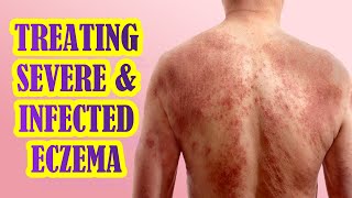 How To Manage Infected and Severe Eczema  Treatment Options [upl. by Ky]