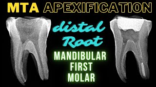 MTA APEXIFICATION  Mandibular First Molar  Apexification Step by Step [upl. by Elyad]