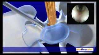 maxMorespine endoscopic animation [upl. by Eiluj]