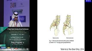 High grade spondylolisthesis decison making in surgical options by Dr Amro Alhabib [upl. by Beore327]