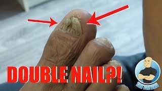 TRIMMING OF A DAMAGED THICKENED SPLIT TOENAIL WITHOUT REMOVAL [upl. by Zel]