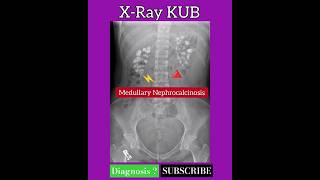 Medullary Nephrocalcinosis  Diagnosis   X Ray KUB  Radiology [upl. by Cony]