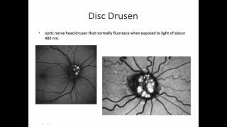 Fluorescein Angiography [upl. by Devitt]