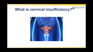 Treatment of Cervical Insufficiency [upl. by Robma]