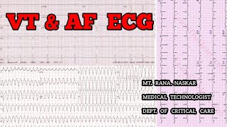 VENTRICULAR TACHYCARDIA amp ATRIAL FIBRILLATION ECG CRITERIAPATIENT FEATURESMT CCU [upl. by Larimor]