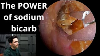 Sodium Bicarbonate Drops VS Earwax amp Dead Skin [upl. by Gardell]