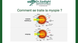 CHIRURGIE REFRACTIVE • Les techniques laser PKR LASIK RELEX SMILE • DR SADIGHI [upl. by Dolan]