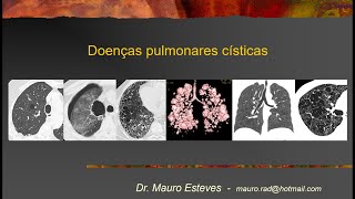 Doenças pulmonares císticas [upl. by Avid]