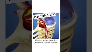 Herniated disc shorts mbbs femalereproductivesystem pregnancy [upl. by Hannon]