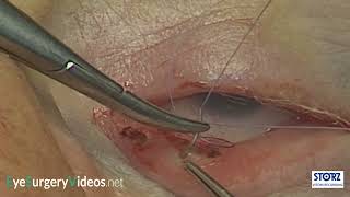 Inferior retractor plication conjunctival approach technique 2 [upl. by Timrek]