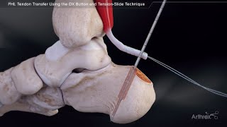 FHL Tendon Transfer Using the DX Button and TensionSlide Technique [upl. by Marj728]