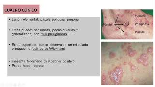 Liquen plano  SOCEM UPEU [upl. by Nrol]