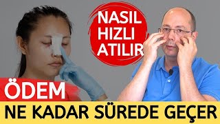 Burun Ameliyatı Sonrası Ödem  Ödem Ne Zaman Geçer Nasıl Hızlı Atılır [upl. by Rina768]