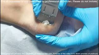 Dead skin remove from heel and Cracked heel treatment [upl. by Elsinore]