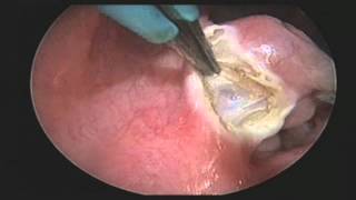 ENT Tonsillectomy with QMR Vesalius Device [upl. by Kirimia]