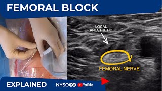 UltrasoundGuided Femoral Nerve Block  Regional anesthesia Crash course with Dr Hadzic [upl. by Azarcon474]