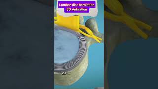 Lumbar Disc Herniation Causes Symptoms amp Treatment  Back Pain Reliefbackpain herniateddisc [upl. by Airrehs]