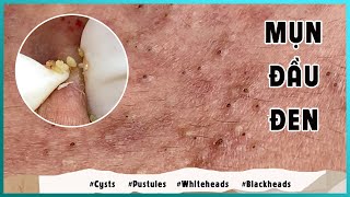 Big Cystic Acne Blackheads Extraction Blackheads amp Milia Whiteheads Removal Pimple Popping [upl. by Ellekram]