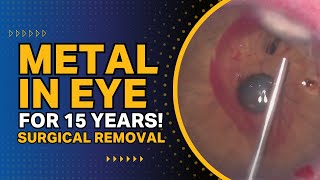 Metal in Eye for 15 Years Surgical Removal [upl. by Atiuqcaj682]