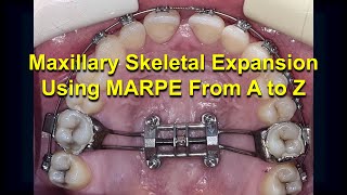 Maxillary Skeletal Expansion using MARPE from A to Z Updated [upl. by Benis582]