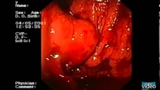 Endotherapy of Gastric Fundal Varices IntraVariceal Injection of NButyl2Cyanoacrylate [upl. by Ettenirt]