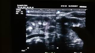 Medullary Nephrocalcinosis Ultrasound [upl. by Nennerb]