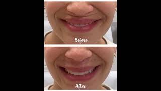 Filler Treatment on Upper Lip Smile Crease  Juvederm Volbella [upl. by Madeleine]