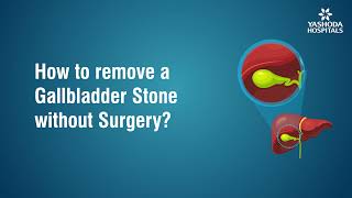 How to remove Gallbladder Stone without surgery [upl. by Valry]