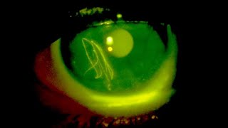 Fluorescein eye stain [upl. by Je]