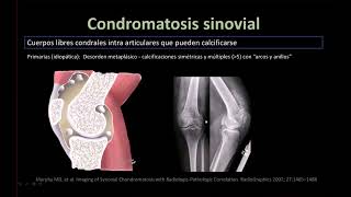 Radiología en 5 minutos Condromatosis sinovial [upl. by Elboa]