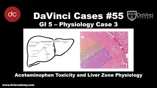 Acetaminophen Toxicity and Liver Zone Physiology DaVinciCases GI 5  Physiology Case 3 [upl. by Aicela]