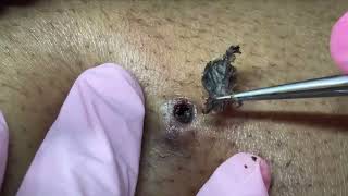 EXTRACTION REMOVAL BLACKHEAD [upl. by Aleekahs134]