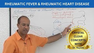 Pathogenesis of Rheumatic Fever  Rheumatic Heart Disease 🧑🏻‍⚕️ [upl. by Regan760]