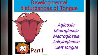 developmental disturbances of TongueOral pathology lecture [upl. by Spear312]