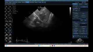 IQ 298 TFAST LUNG MEDIASTINAL LYMPHOID NODE ENLARGEMENT HWD ECHOPAC ANALYSIS [upl. by Ecirehs509]