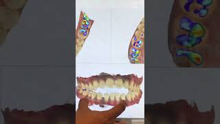 Invisalign Time Lapse  Invisalign Braces  Invisalign Before After invisalignsmile clearaligner [upl. by Rola]