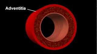 Atherosclerotic disease [upl. by Tessie859]