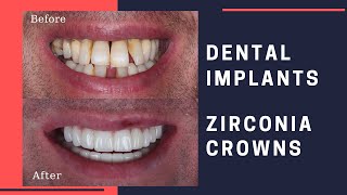 Dental Implants amp Zirconia Crowns Patient Review [upl. by Teague]