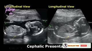 Breech BabyBaby presentation on ultrasound [upl. by Trainer747]