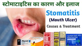 Mouth Ulcer Treatment  Stomatitis causes amp Treatment [upl. by Noizneb]