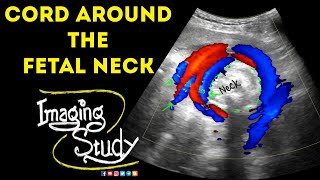 Umbilical Cord Around The Fetal Neck  Ultrasound  Doppler  Case 46 [upl. by Giraldo]