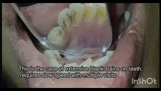 Dental scaling and Polishing [upl. by Standish]