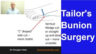 Tailors Bunion Surgery  Seattle Podiatrist [upl. by Thgiwed]