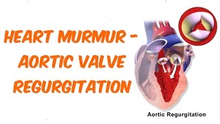 Aortic Regurgitation Auscultation Sound [upl. by Atirrehs]