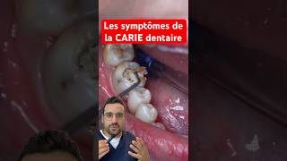 Les symptômes de la CARIE dentaire [upl. by Carrington]