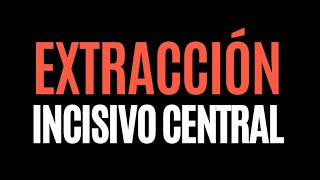 Extracción del incisivo central ⚠️ [upl. by Nnayelhsa]