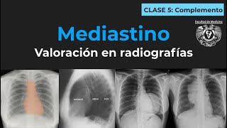 04 y 05  Alteraciones mediastinales en radiografía de tórax Complemento [upl. by Maclean]