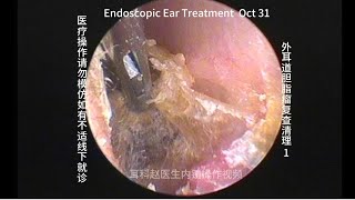 Re examination and cleaning of external auditory canal cholesteatoma 20241031 [upl. by Sears]